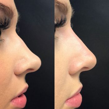 nose contour with fillers