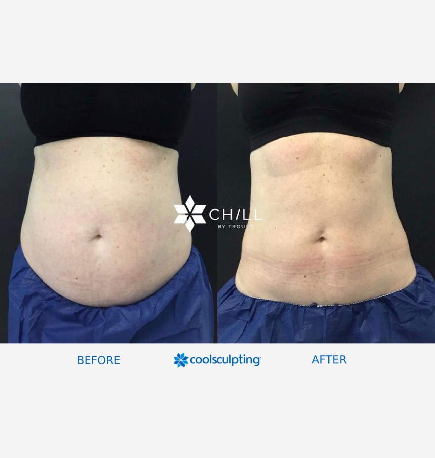 Does CoolSculpting Work? Fat Freezing Costs and Results